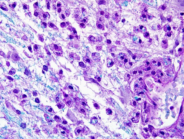 11C3 Inflammatory Demyelination (Tumefactive MS, Case 11) LFB-PAS 3