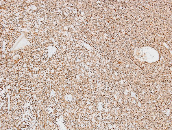 11D1 Inflammatory Demyelination (Tumefactive MS, Case 11) NF 4