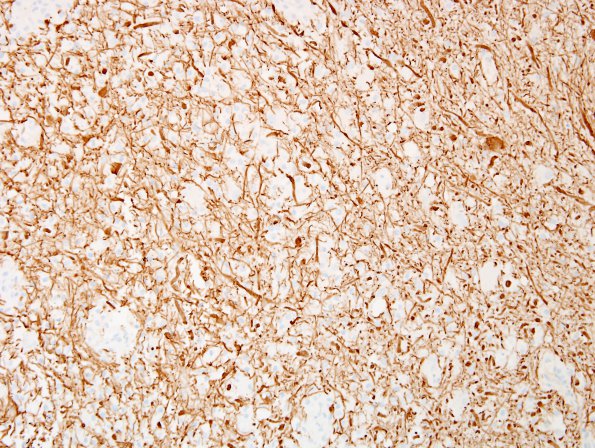 11D2 Inflammatory Demyelination (Tumefactive MS, Case 11) NF 1