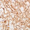 11D3 Inflammatory Demyelination (Tumefactive MS, Case 11) NF 2 copy