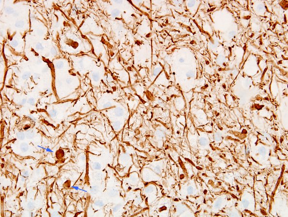 11D3 Inflammatory Demyelination (Tumefactive MS, Case 11) NF 2 copy