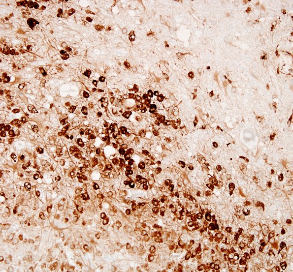 11E1 Inflammatory Demyelination (Tumefactive MS, Case 11) CD68 4