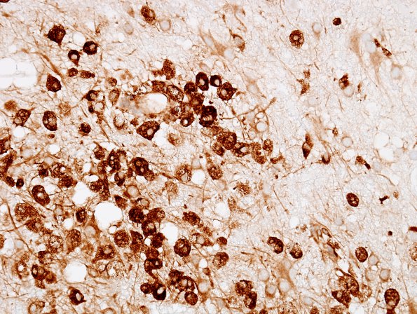 11E3 Inflammatory Demyelination (Tumefactive MS, Case 11) CD68 3