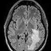 12A1 Inflammatory Demyelination (Case 12) T2 FLAIR