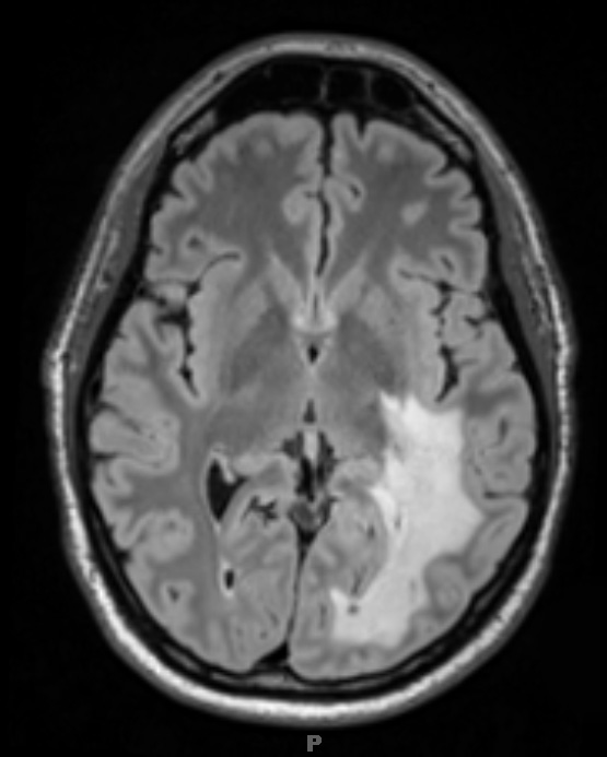 12A1 Inflammatory Demyelination (Case 12) T2 FLAIR