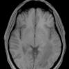 12A2 Inflammatory Demyelination (Case 12) T1 without contrast