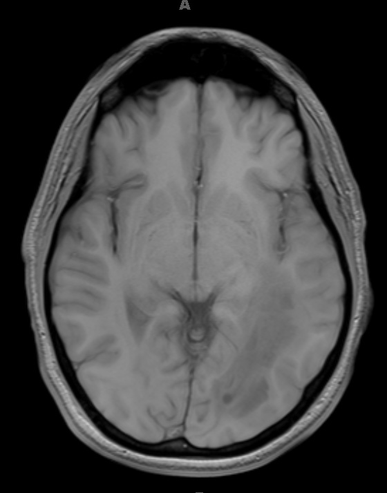 12A2 Inflammatory Demyelination (Case 12) T1 without contrast