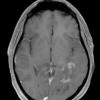 12A3 Inflammatory Demyelination (Case 12) T1 with contrast