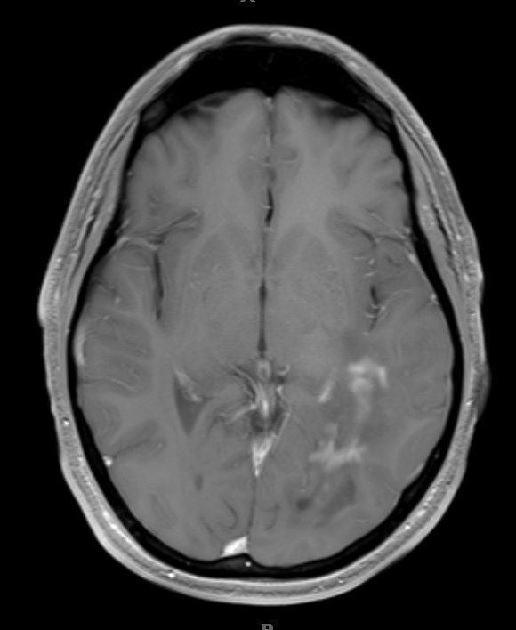 12A3 Inflammatory Demyelination (Case 12) T1 with contrast