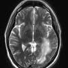 12A4 Inflammatory Demyelination (Case 12) T2 with contrast