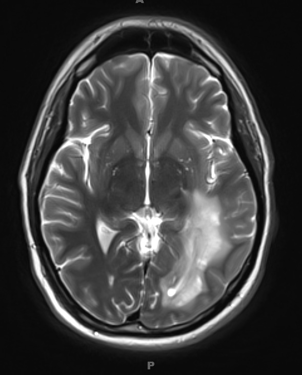 12A4 Inflammatory Demyelination (Case 12) T2 with contrast