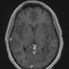 12A5 Inflammatory Demyelination (Case 12) T1 with contrast  2 wks later