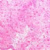 12B1 Inflammatory demyelination (Case 12) frozen section 10X