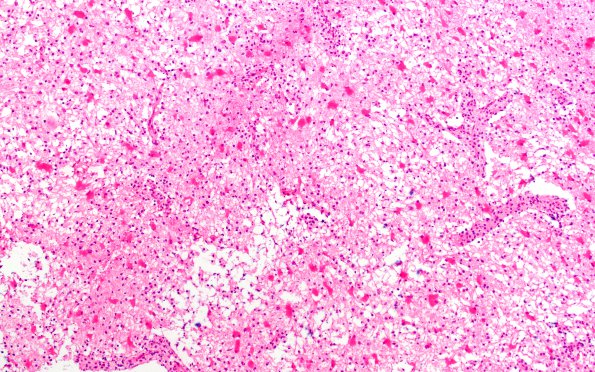 12B1 Inflammatory demyelination (Case 12) frozen section 10X