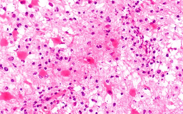 12B2 Inflammatory demyelination (Case 12) frozen section 40X