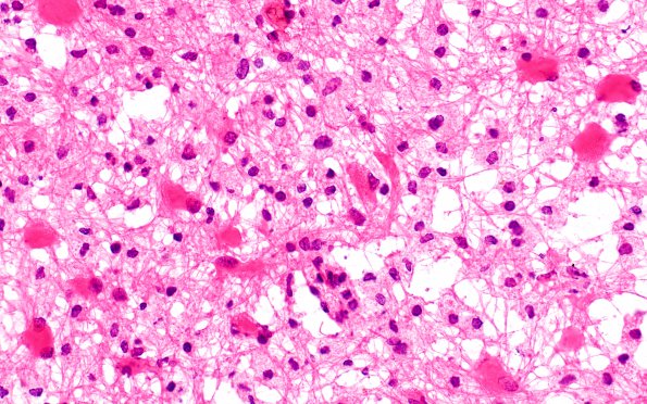 12B3 Inflammatory demyelination (Case 12) frozen section 40X