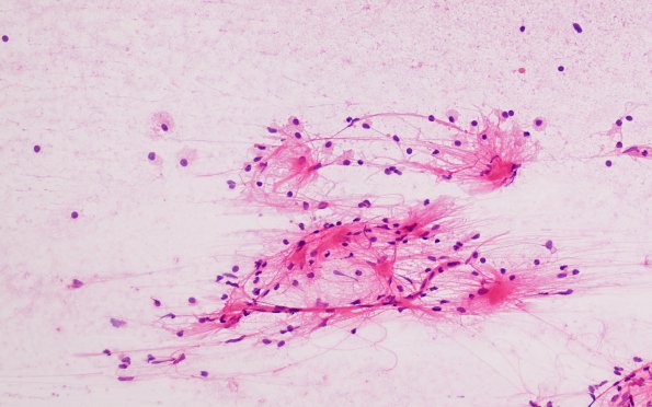 12B4 Inflammatory demyelination (Case 12) smear H&E 20X