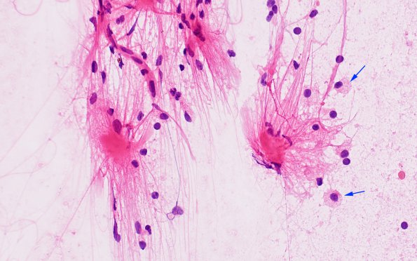 12B5 Inflammatory demyelination (Case 12) smear H&E 40X copy