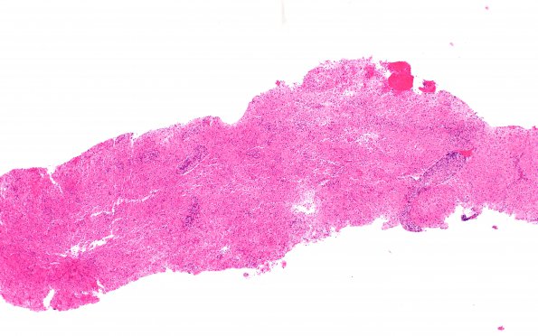 12C1 Inflammatory demyelination (Case 12) H&E 5