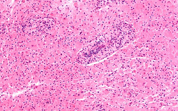 12C2 Inflammatory demyelination (Case 12) H&E 4