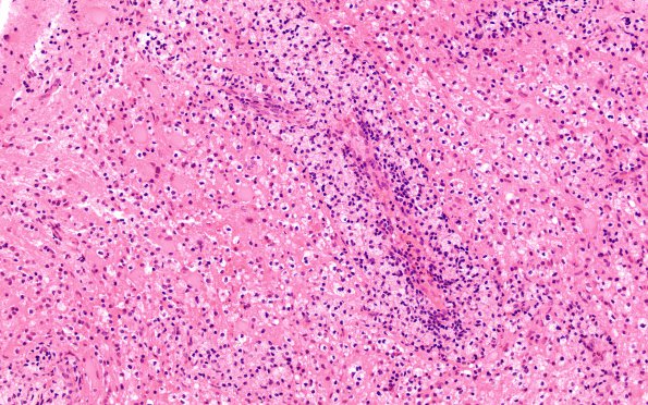 12C3 Inflammatory demyelination (Case 12) H&E 2