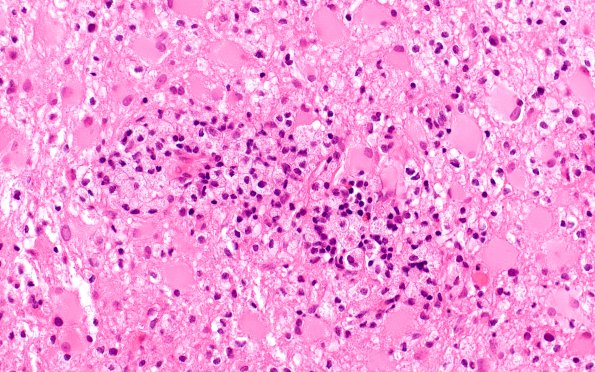 12C4 Inflammatory demyelination (Case 12) H&E 1