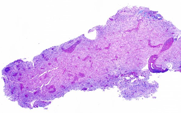 12D1 Inflammatory demyelination (Case 12) LFB-PAS 4X