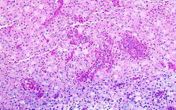 12D2 Inflammatory demyelination (Case 12) LFB-PAS 20X