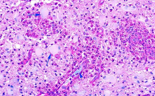 12D3 Inflammatory demyelination (Case 12) LFB-PAS 40X copy