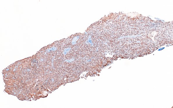 12E1 Inflammatory demyelination (Case 12) NF 4X