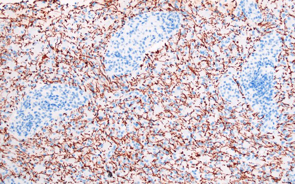 12E2 Inflammatory demyelination (Case 12) NF 20X