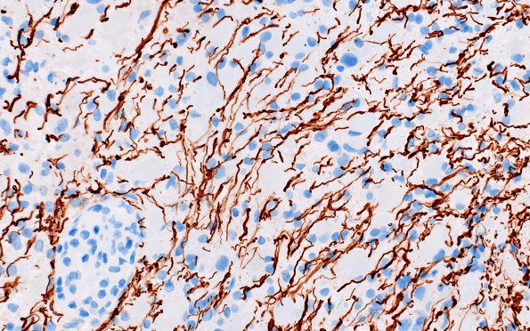 12E3 Inflammatory demyelination (Case 12) NF 40X