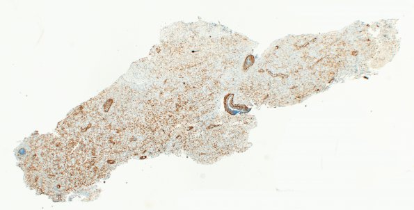 12F1 Inflammatory demyelination (Case 12) CD163 4X