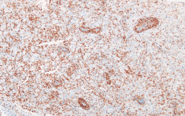 12F2 Inflammatory demyelination (Case 12) CD163 20X 3