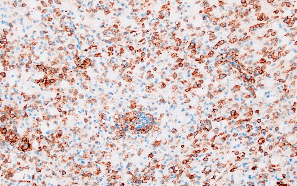 12F3 Inflammatory demyelination (Case 12) CD163 20X