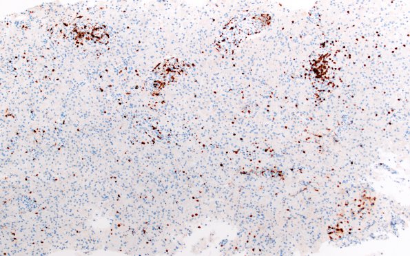 12G2 Inflammatory demyelination (Case 12) CD3 20X