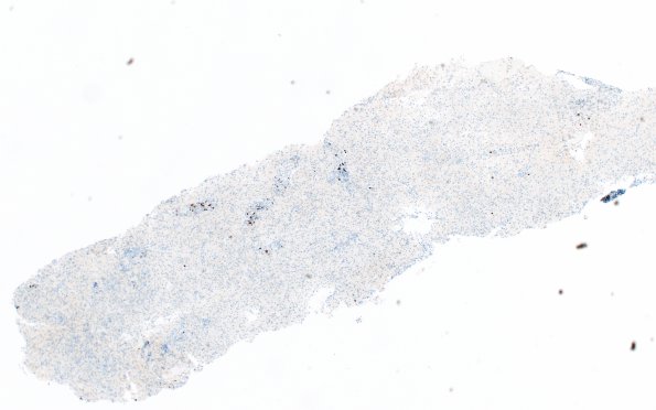 12H1 Inflammatory demyelination (Case 12) CD20 4X