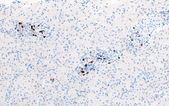 12H2 Inflammatory demyelination (Case 12) CD20 1