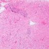 13A1 Inflammatory demyelination (Case 13) Area 1 10X 2