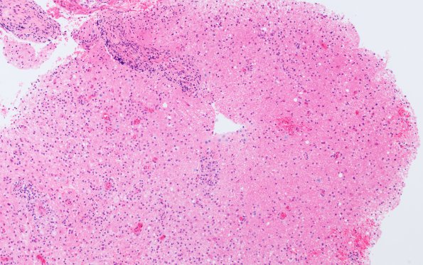 13A1 Inflammatory demyelination (Case 13) Area 1 10X 2