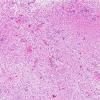 13A2 Inflammatory demyelination (Case 13) H&E 3