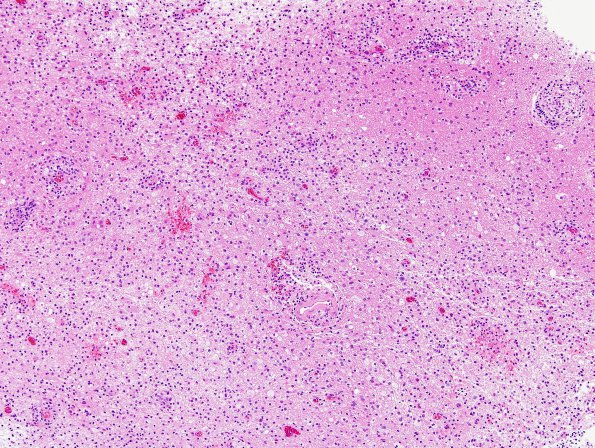 13A2 Inflammatory demyelination (Case 13) H&E 3