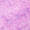 13A3 Inflammatory demyelination (Case 13) H&E 2