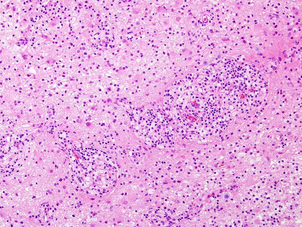 13A3 Inflammatory demyelination (Case 13) H&E 2