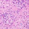 13A4 Inflammatory demyelination (Case 13) H&E 1 copy