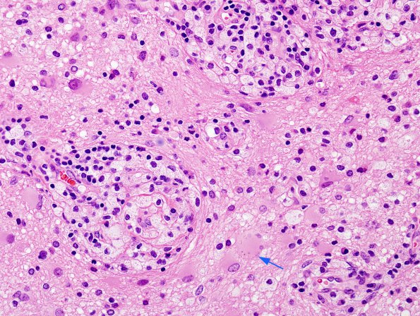 13A4 Inflammatory demyelination (Case 13) H&E 1 copy