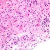 13A5 Inflammatory demyelination (Case 13) H&E 40X