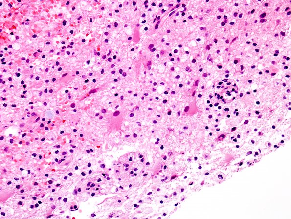 13A5 Inflammatory demyelination (Case 13) H&E 40X