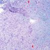 13B1 Inflammatory demyelination (Case 13) Area 1 LFB-PAS 10X copy