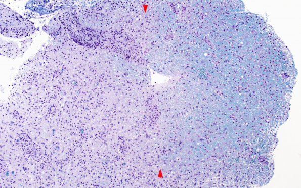 13B1 Inflammatory demyelination (Case 13) Area 1 LFB-PAS 10X copy